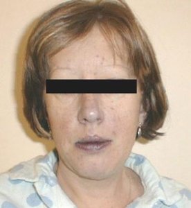 Cyanosis in lips and fingers
