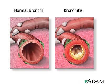 Alveoli with emphysema vs. normal alveoli