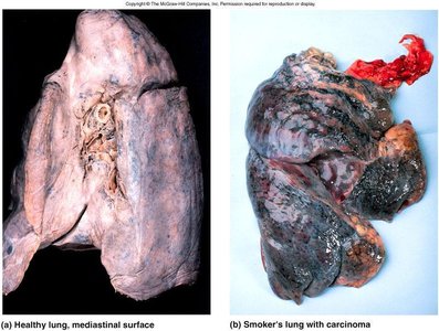 Normal bronchi vs. bronchitis