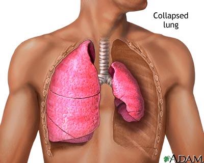 Collapsed lung illustration