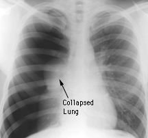 X-ray of collapsed lung
