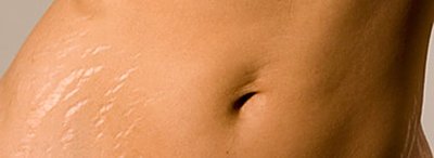 Photo of stretch marks (striae) on skin