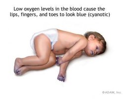 Cyanosis due to low oxygen