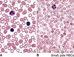 Blood smear: normal vs. iron deficiency anemia