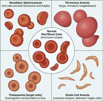 RBC morphology in different anemias