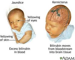 HDN: maternal antibodies attacking fetal RBCs