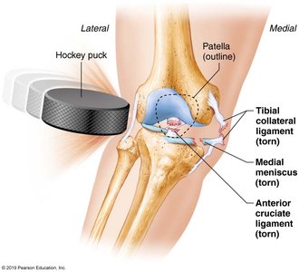 Unhappy triad knee injury