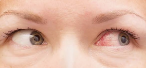 Photo of conjunctivitis (pinkeye)