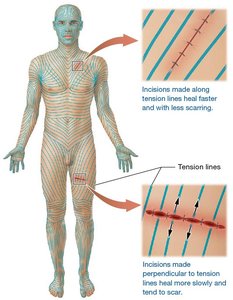 Tension lines and surgical incisions