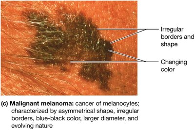 Malignant melanoma