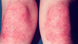 Patient with nemaline myopathy