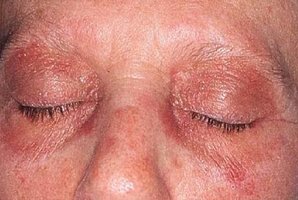 Polymyositis and dermatomyositis symptoms and signs