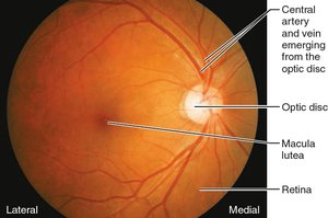 Fundus of the right eye as seen with an ophthalmoscope