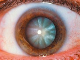 Photograph of a cataract