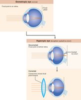 Problems of refraction: hyperopia