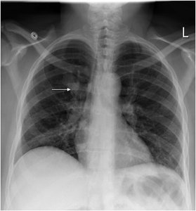 Chest X-ray showing azygos lobe