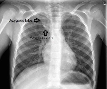 Chest X-ray with labeled azygos lobe and vein