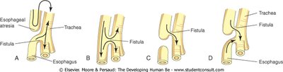 Diagram of tracheoesophageal fistula types