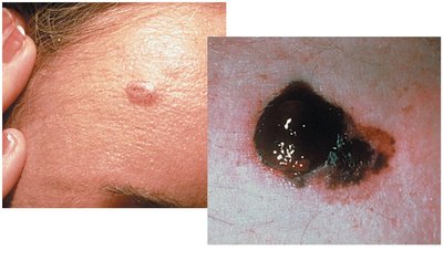 Basal cell carcinoma and melanoma