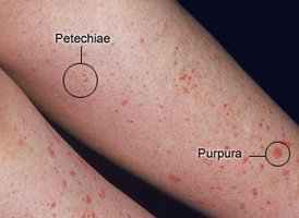 Petechiae and purpura due to thrombocytopenia
