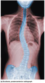 Scoliosis, posteroanterior radiograph