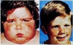 Symptoms of Cushing's syndrome