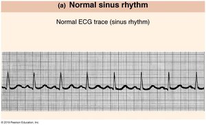 Normal sinus rhythm ECG