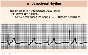 Junctional rhythm ECG