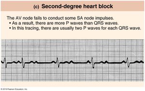 Second-degree heart block ECG