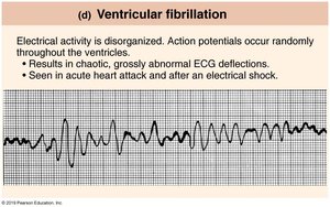 Ventricular fibrillation ECG