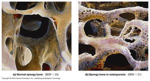 Normal spongy bone vs. spongy bone in osteoporosis