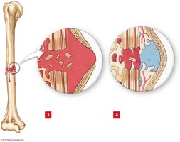 Callus formation in bone fracture repair