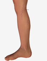 Varicose veins in the leg