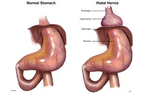 Hiatal hernia