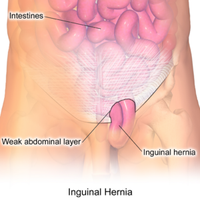 Inguinal hernia