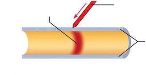 Depolarization in a graded potential