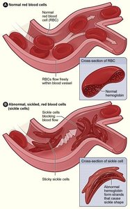Normal vs. sickled red blood cells