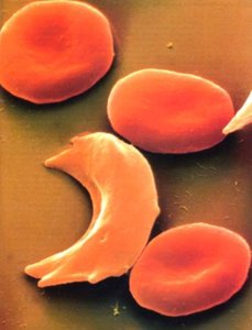 Sickled red blood cell under microscope