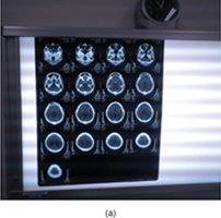 CT scan results