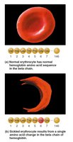 Sickle-cell anemia: normal vs. sickled erythrocyte