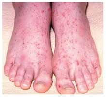 Petechiae: sign of thrombocytopenia