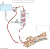 Diagram of hemodialysis process