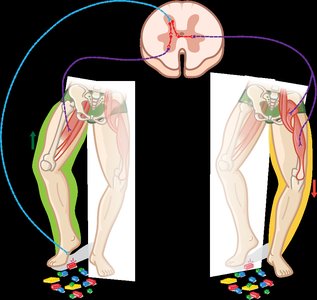Crossed-extensor reflex: withdrawal and extension of opposite limb