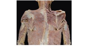 Cadaver dissection of posterior thoracic muscles