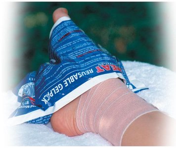 Carpal tunnel syndrome with compressed median nerve