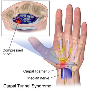 Shoulder joint with inflamed bursa (bursitis)