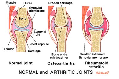 Normal, osteoarthritic, and rheumatoid arthritic joints