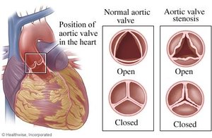 Normal and stenotic aortic valve comparison