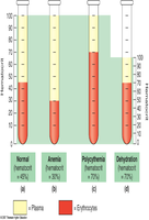 Hematocrit test tubes: normal, anemia, polycythemia, dehydration