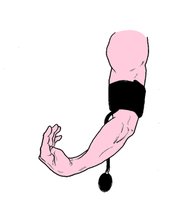 Illustration of Trousseau's sign (carpal spasm)